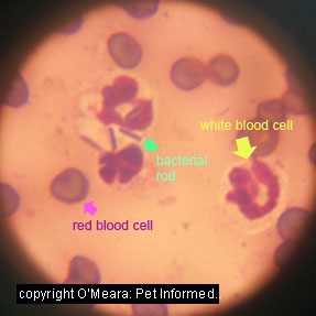 This is a smear of infected urine (termed a urinary tract infection). It depicts several neutrophils, one of which has ingested several bacterial rods. These rods will be destroyed inside the cell.