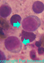 Image of lymphocytes (indicated with arrows).