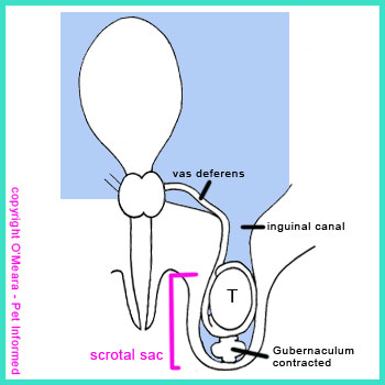The descended testicle is held in place by gubernacular regression. This does not happen in undescended testes.