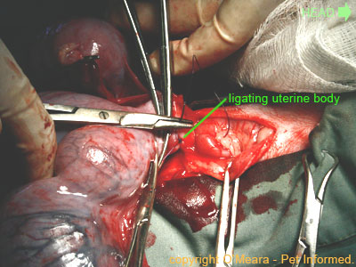 Pregnant spay image - The surgeon has tied off each of the uterine vessels separately.