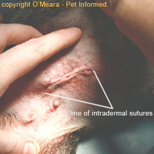 This is a line of intradermal skin sutures. You can not see the sutures and they do not require removal.