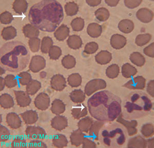 This is a normal blood smear of a dog, showing some of the white bloods cells which circulate around the body via the blood. The cells depicted are neutrophils and macrophages.