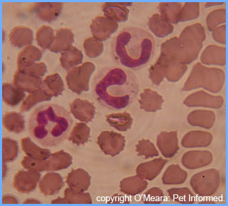 The two cells with the horseshoe shapednuclei are bands: immature neutrophils released into the blood in times of high infection.